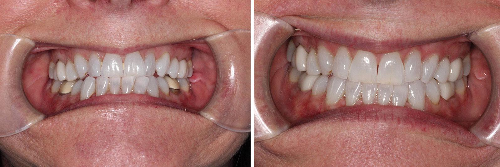 Clear Aligner Ortho Treatment