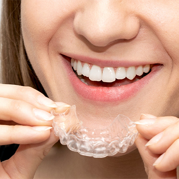 clear aligners